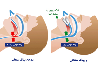 نحوه استفاده از پلاک ضد خروپف (Anti snore mouthpiece)